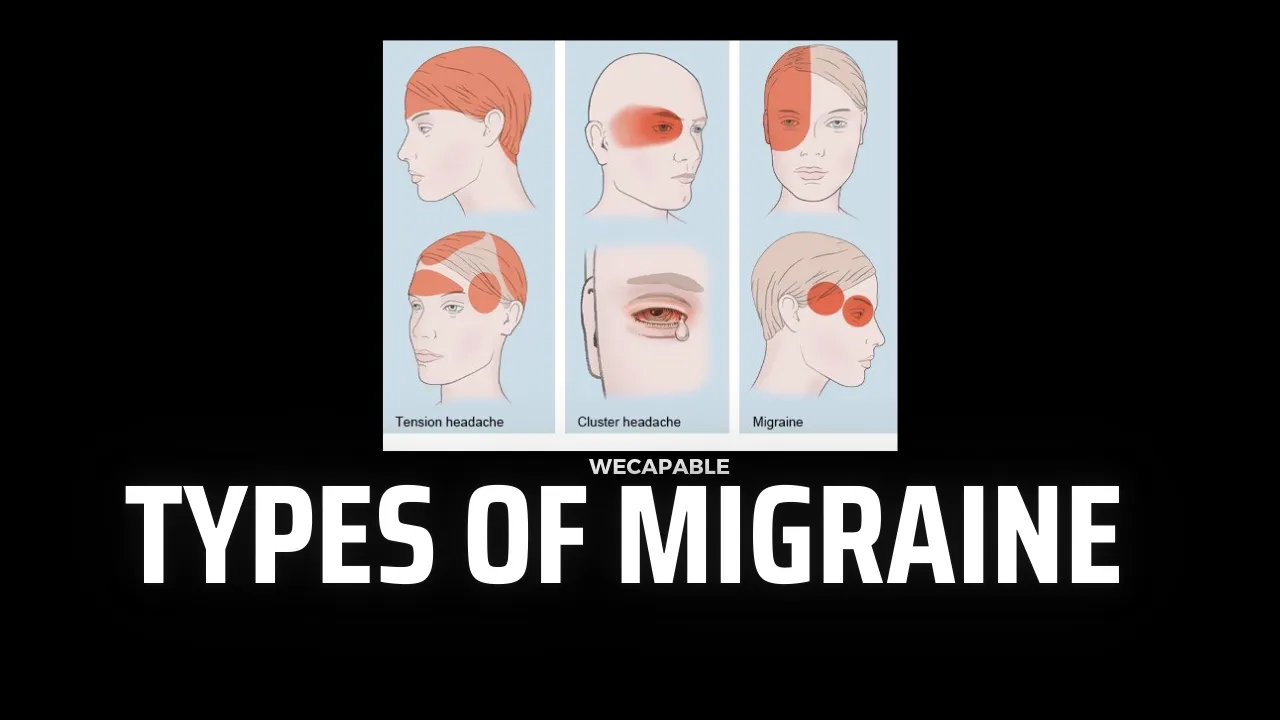Understanding Types of Migraine