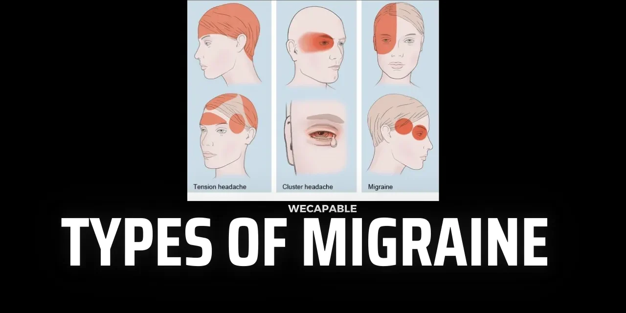 Understanding Types of Migraine