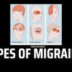 Understanding Types of Migraine